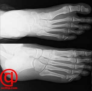 igne-yabanci-cisim xray