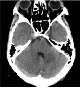 transvers sinus trombozu