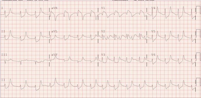 genis-qrs