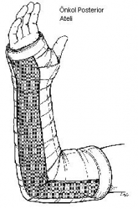 atel uzun posterior