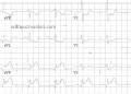 sag-EKG-Inf-Post-STEMI-v-4-6R