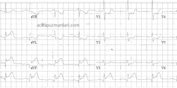 sag-EKG-Inf-Post-STEMI-v-4-6R