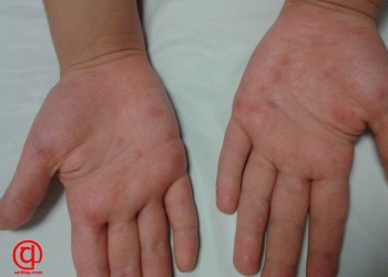 Döküntülü hastalıklar