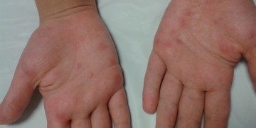 Döküntülü hastalıklar