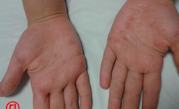 Döküntülü hastalıklar