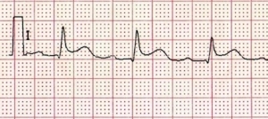 ARanterior-STEMI-evolving