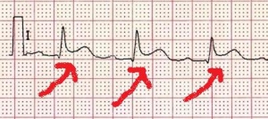 Kanterior-STEMI-evolving