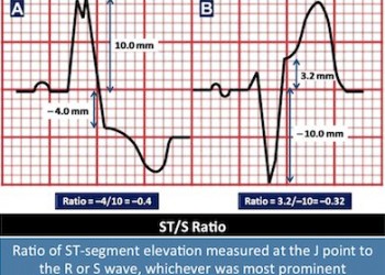 Sgarbossa Kriteri ve Modifiye Skarbossa Kriterleri