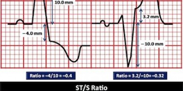 Sgarbossa Kriteri ve Modifiye Skarbossa Kriterleri
