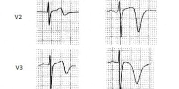 Wellen’s Sendromu Nedir?