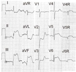 sag-ventrikul-Mi01