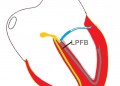 LPFB