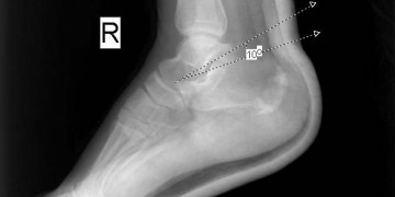 Ekstremite Kırıkları-5