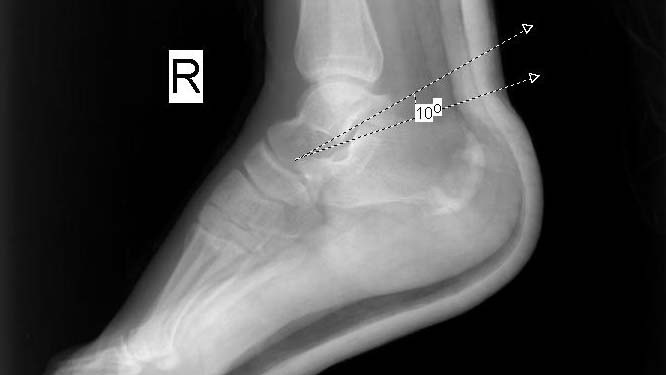 Ekstremite Kırıkları-5