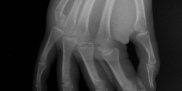 Ekstremite Kırıkları-6