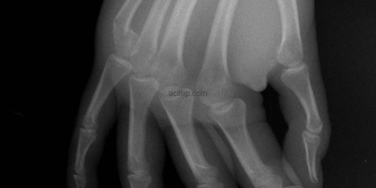 Ekstremite Kırıkları-6