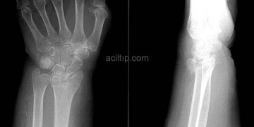 Colles kırığı nedir