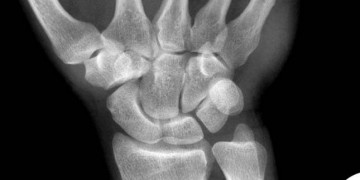 metakarpal kemik kırığı