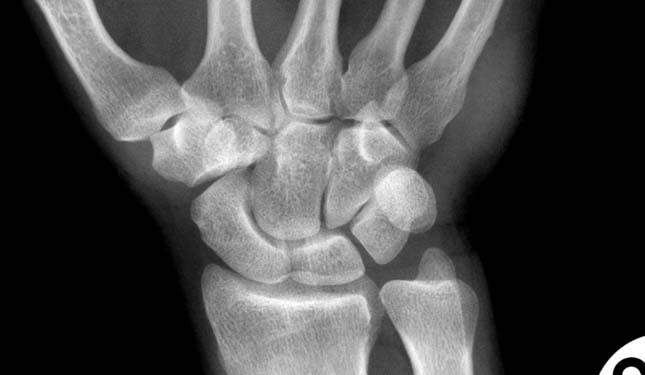 metakarpal kemik kırığı