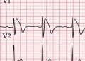 Brugada Sendromu Nedir?