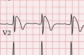 Brugada Sendromu Nedir?