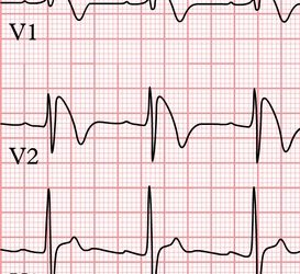 Brugada Sendromu Nedir?