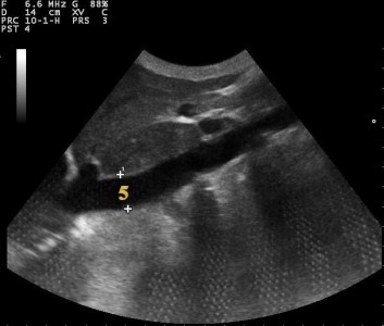 inferior vena kava