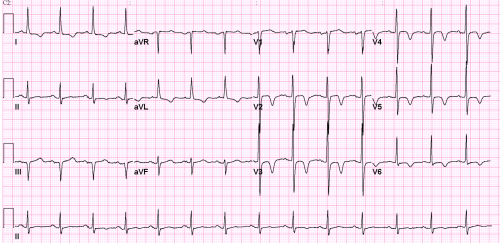 ECG_SAB