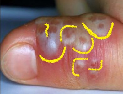 herpes finger
