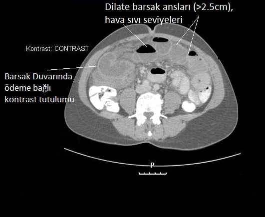 incebarsak obstrüksiyonu, incebarsak obstrüksiyonu