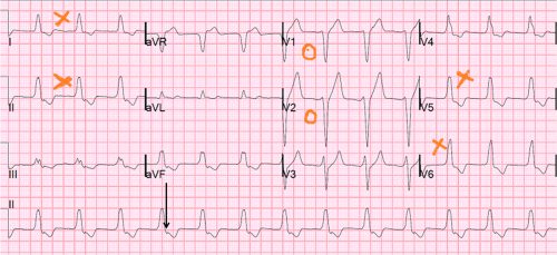 left bundle block