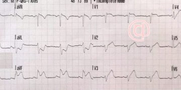 EKG Soruları 1
