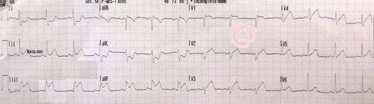 EKG Soruları 1
