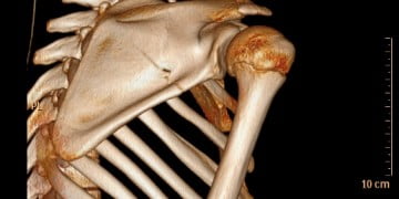 skapula kırığı 3D