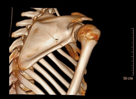 skapula kırığı 3D