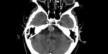 baziller arter anevrizmatik genişleme