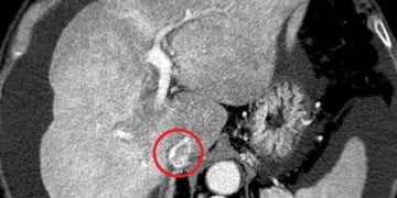 Portal ven trombozu nedir?