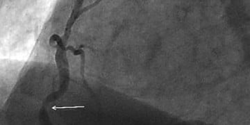 Kounis sendromu nedir?