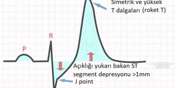 de wintert t dalgası