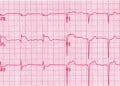 EKG Soruları 031