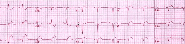 EKG Soruları 032