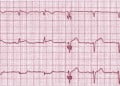 EKG Soruları 033