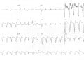 EKG Soruları 034