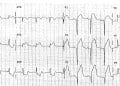 EKG Soruları 036