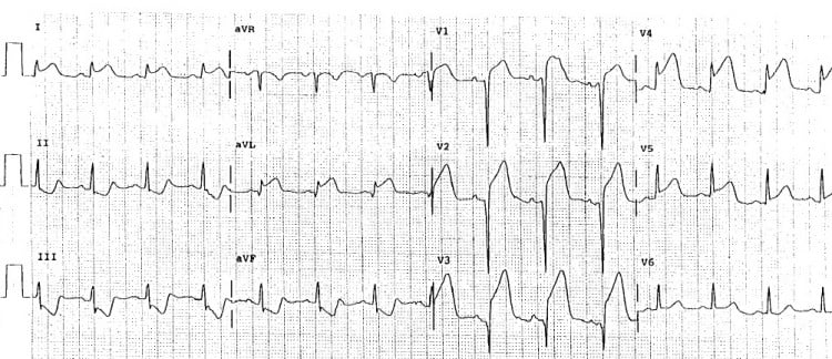 EKG Soruları 036