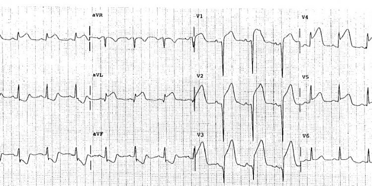 EKG Soruları 036
