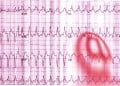 EKG Soruları 028