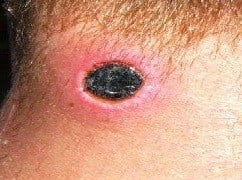 Şarbon Hastalığı