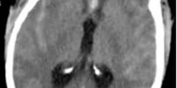 Subaraknoid kanama nedir?