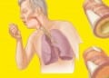 Hemoptizi Nedir?